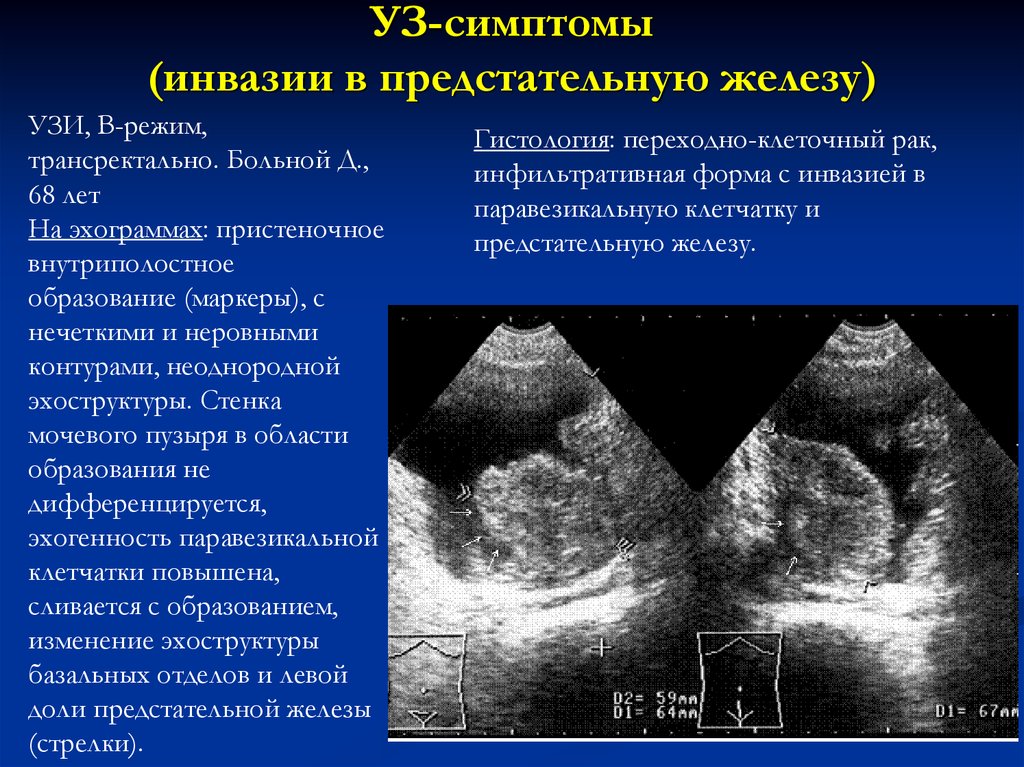 Диагноз гиперплазия предстательной железы. Гиперплазия предстательной железы УЗИ. УЗИ мочевого пузыря заключение. Диффузно неоднородное изменение структуры предстательной железы. УЗИ строение предстательной.