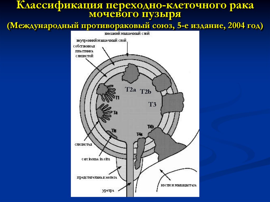 Классификация переходно-клеточного рака мочевого пузыря (Международный противораковый союз, 5-е издание, 2004 год)