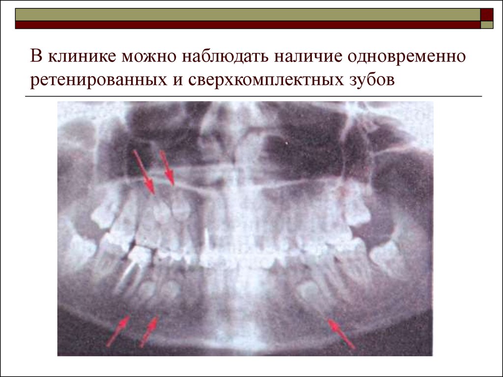 Наличие одновременно. Сверхкомплектные зубы аномалия. Сверхкомплектные и ретенированные зубы презентация. Клейдокраниальной дисплазии зубов. Диагностика и лечение аномалий зубов.