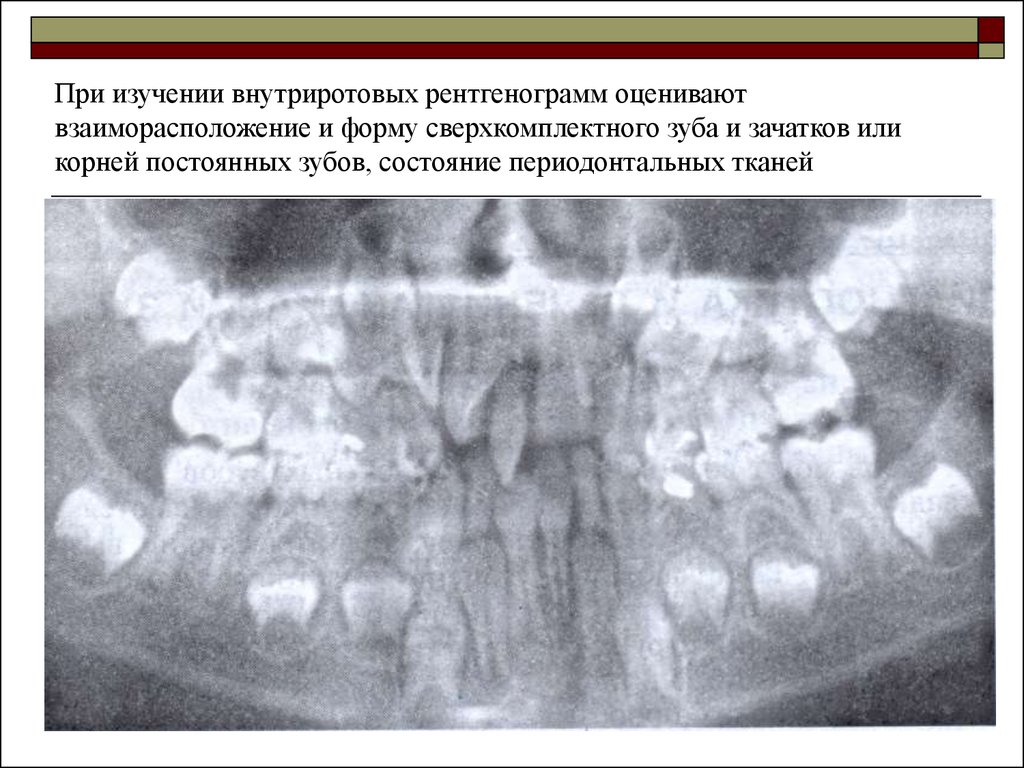 Рентгенологическая картина зубов и их зачатков на различных этапах формирования