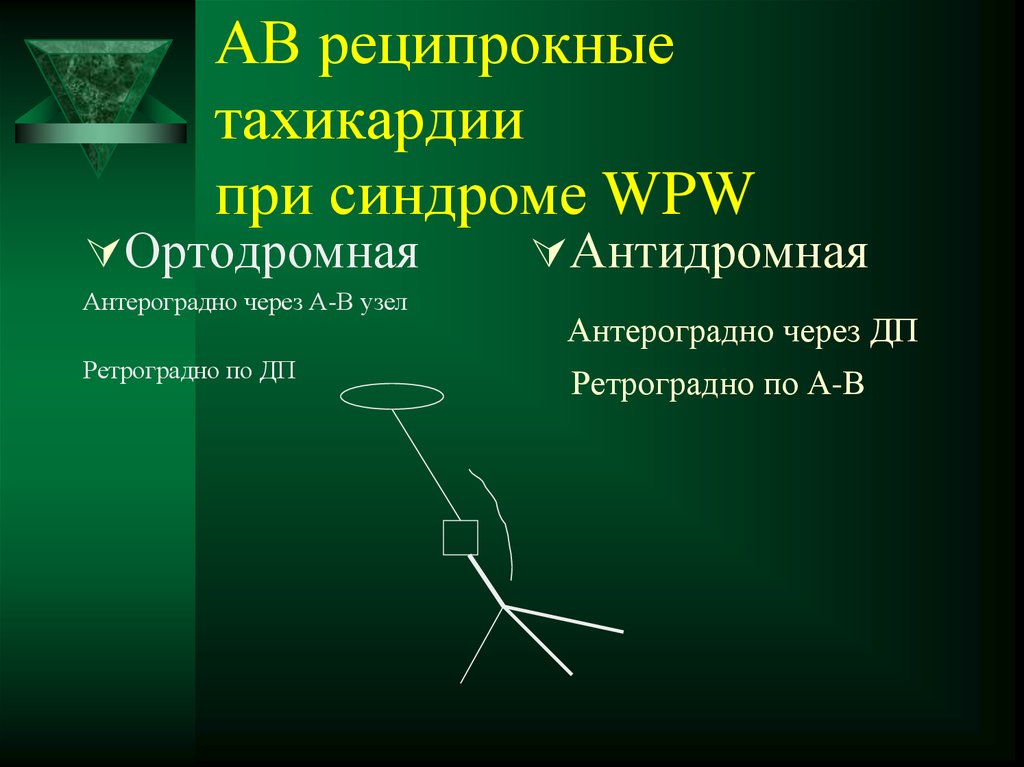 АВ реципрокные тахикардии при синдроме WPW