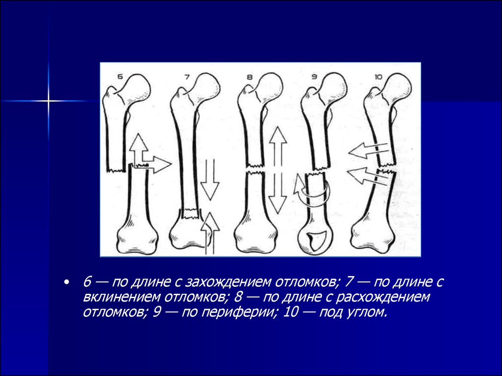 Смещение отломков кости. Перелом бедренной кости с расхождением отломков. Перелом с захождением отломков. Перелом с захождением отломков по длине. Косой перелом с захождением отломков.