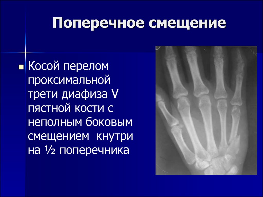 Смещение отломков кости. Перелом проксимальной 1 3 диафиза пястной кости. Винтообразный перелом диафиза пятой пястной кости. Косой перелом диафиза пястной кости. Перелом проксимального метаэпифиза пястной кости.