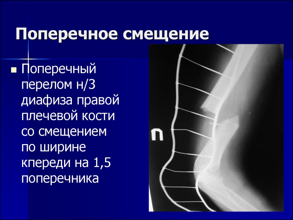 Перелом н 3. Смещение. Лучевая диагностика костно-суставной системы. Поперечное смещение. Трансверсальный сдвиг.