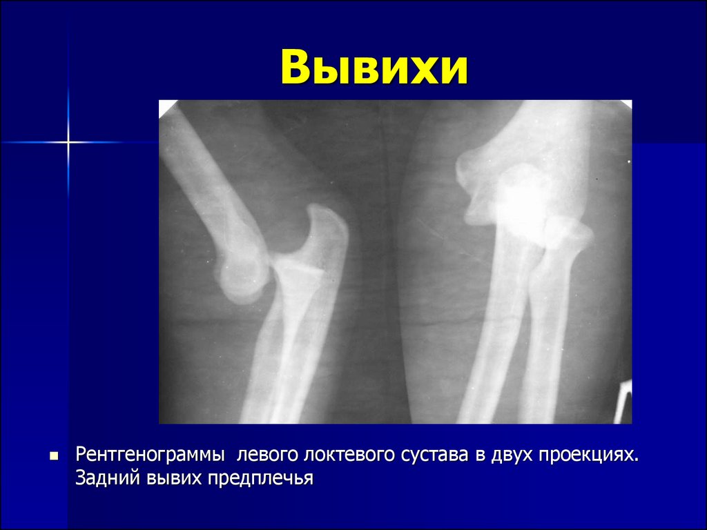 Рентгеновская картина переломов и вывихов костей