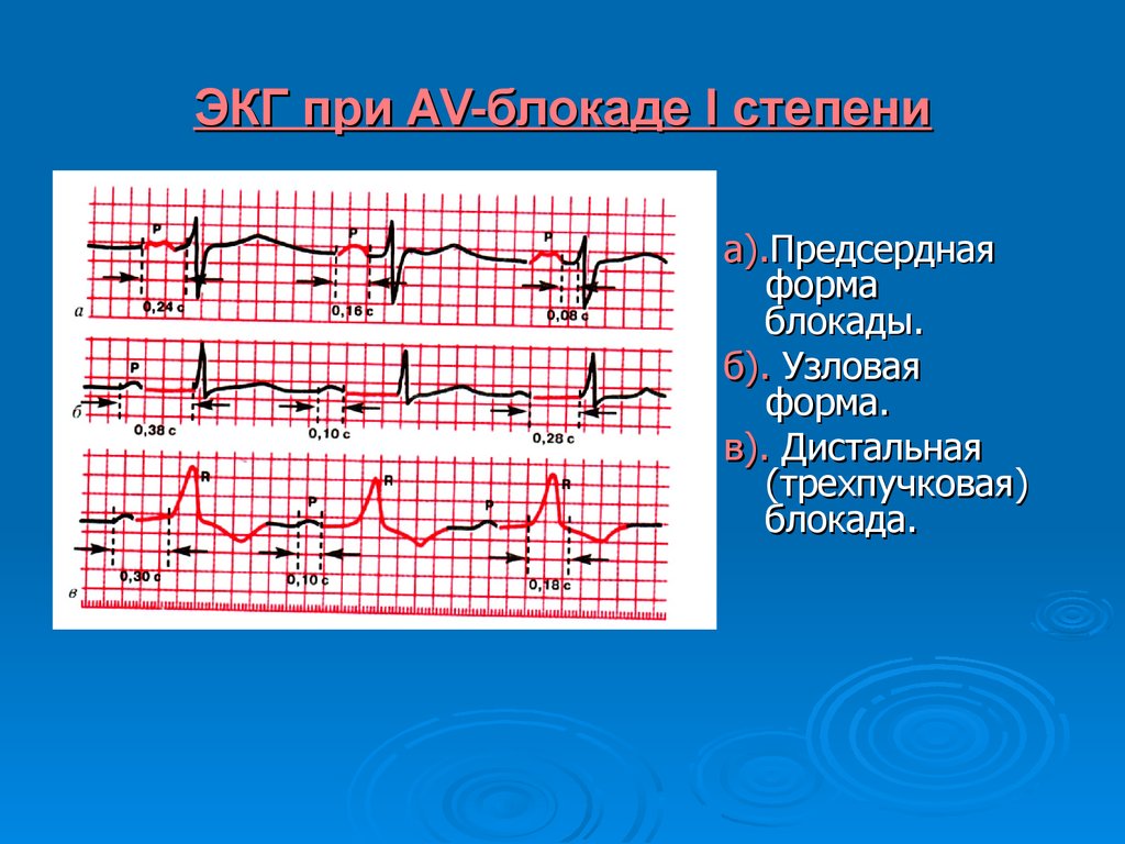 Что значат блокады на экг. ЭКГ при трехпучковой блокаде. Трехпучковая блокада ножек пучка Гиса ЭКГ. Дистальная АВ блокада 1 степени. Трехпучковые блокады ножек пучка Гиса на ЭКГ.