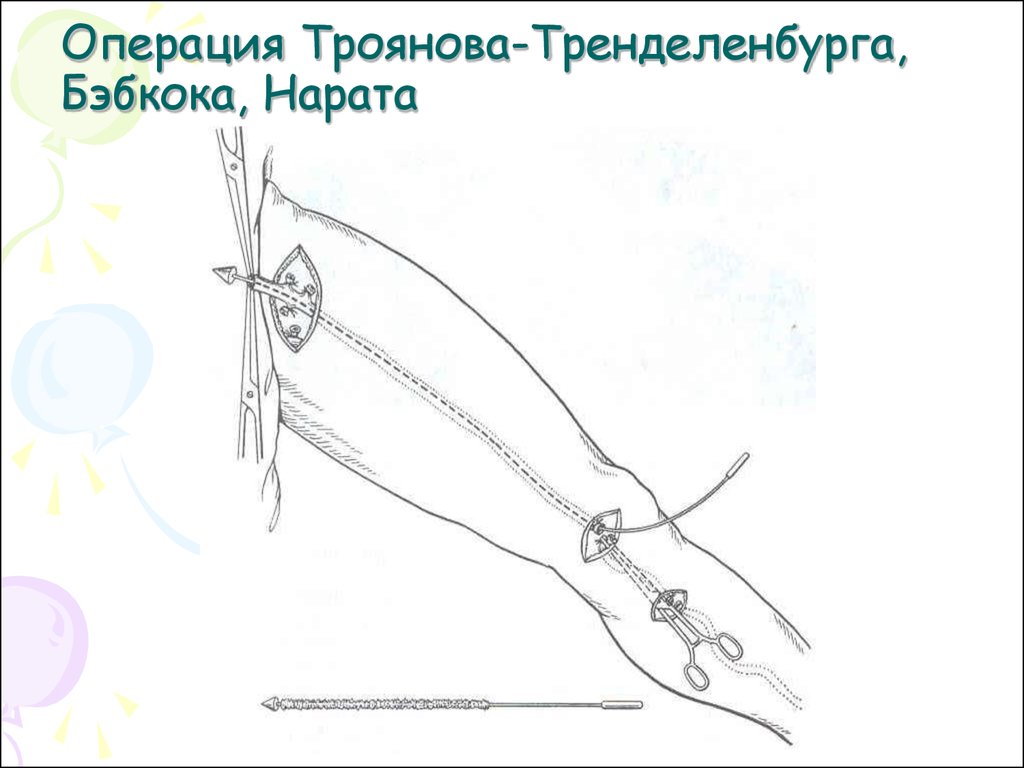 Перевязка подкожных вен. Операция Троянова-Тренделенбурга Бэбкока Нарата. Кроссэктомия операция Троянова Тренделенбурга. Операция Троянова-Тренделенбурга техника операции. Флебэктомия Троянова-Тренделенбурга техника.