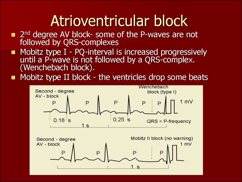 Atrioventricular block