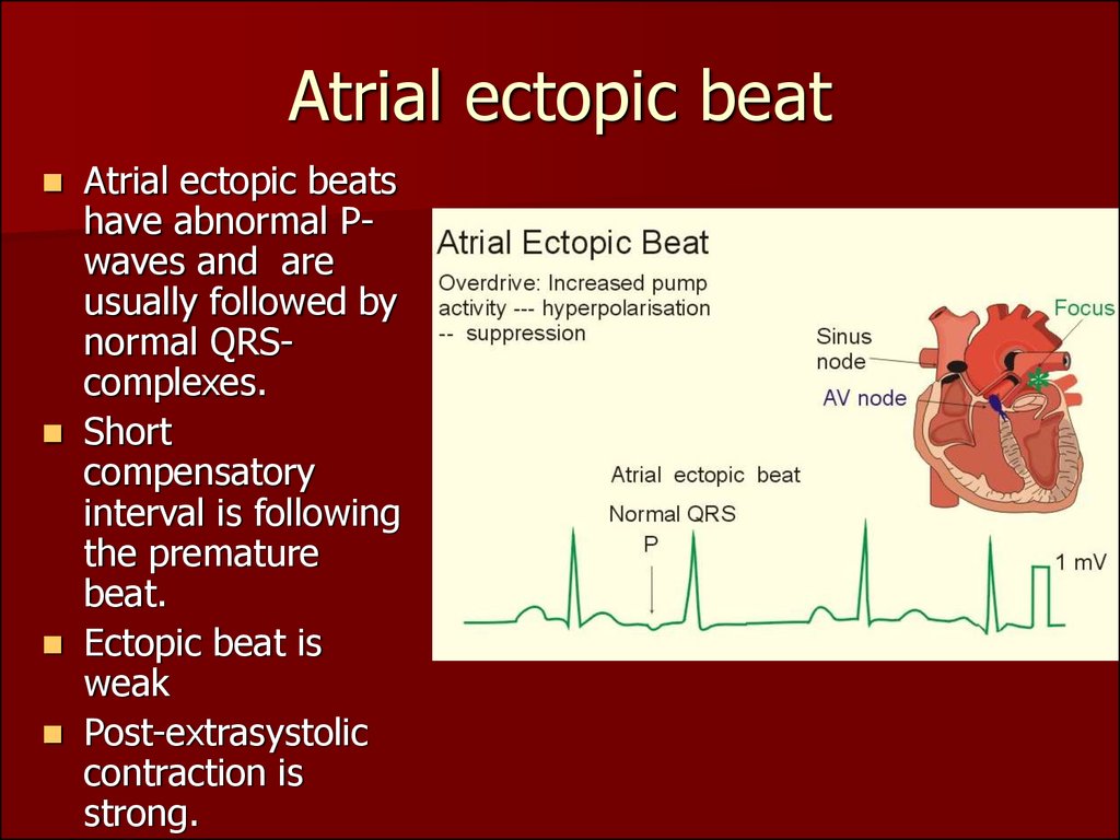 Atrial ectopic beat