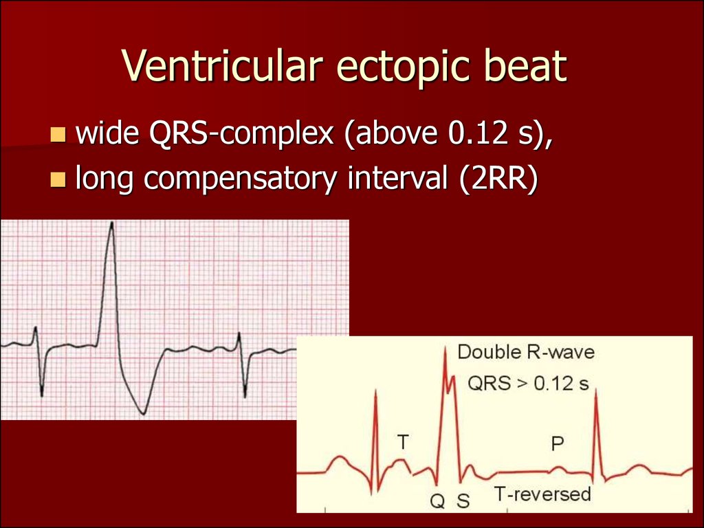 frequent ectopic beats