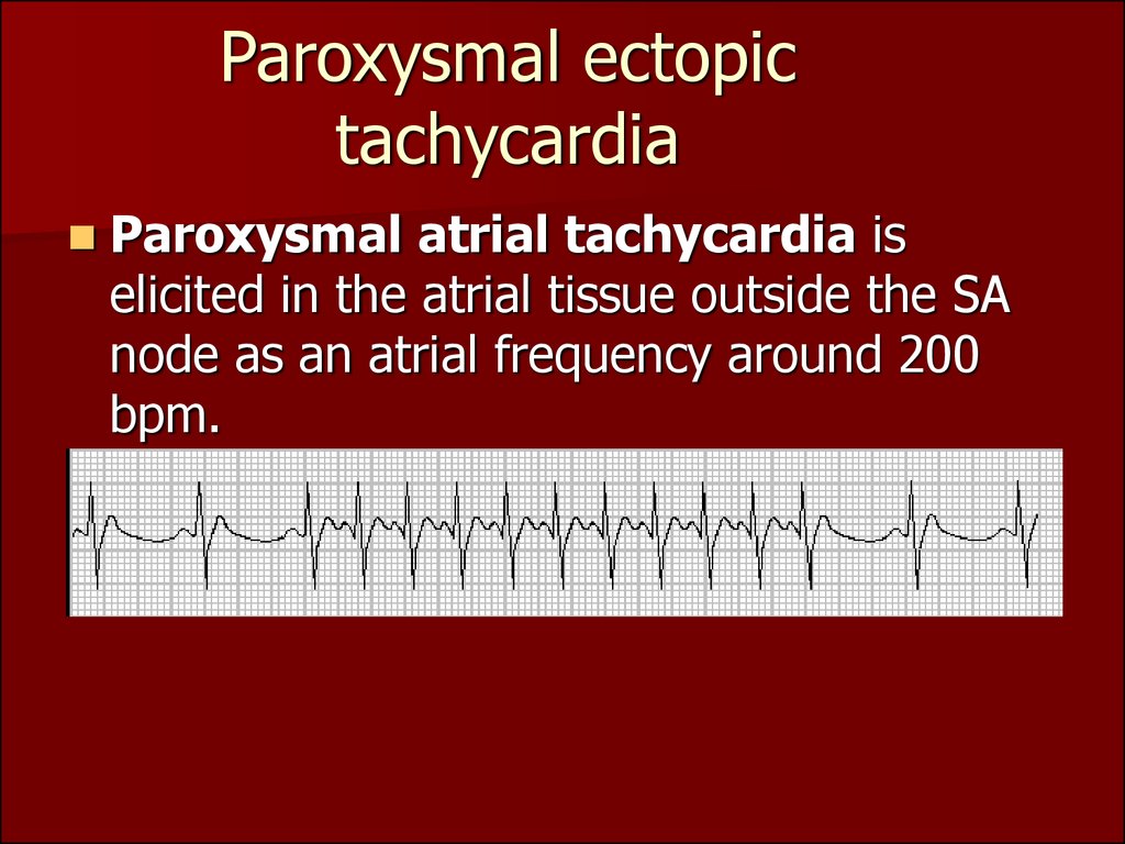 Paroxysmal ectopic tachycardia