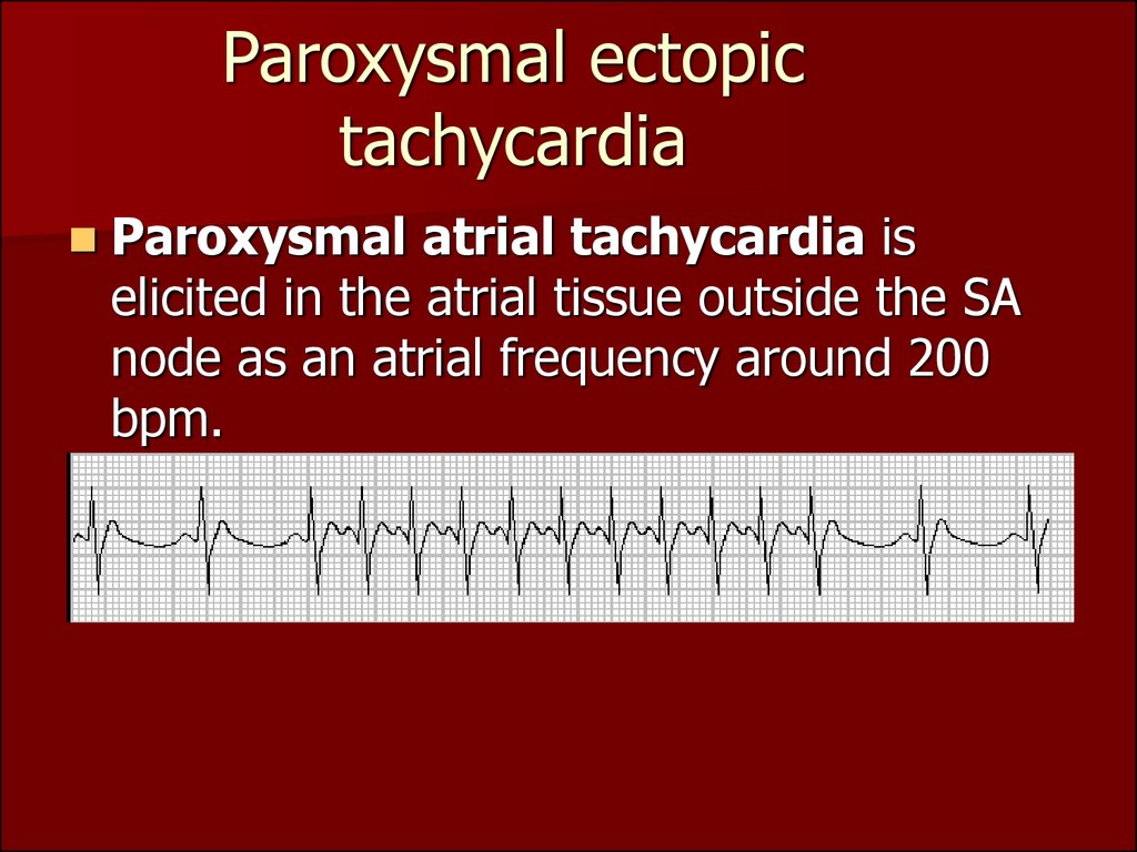 Paroxysmal Atrial Tachycardia