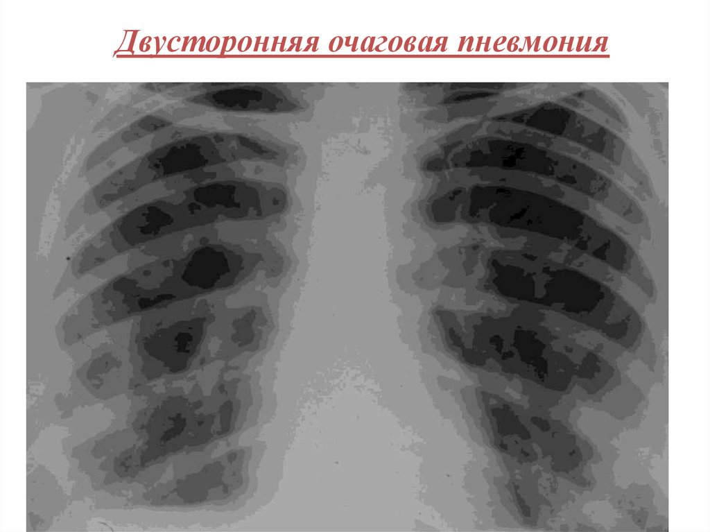 Осложнения очагов пневмонии. Очаговая пневмония рентген. Рентген при двусторонней пневмонии. Двухсторонняя пневмония рентген. Двусторонняя очаговая пневмония.