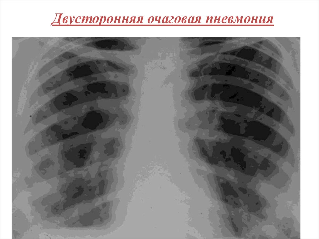 Двухсторонняя пневмония. Двухсторонняя очаговая пневмония. Двухсторонняя очаговая пневмония рентген. Двусторонняя пневмония снимок легких. Рентген легких пневмония двухсторонняя.