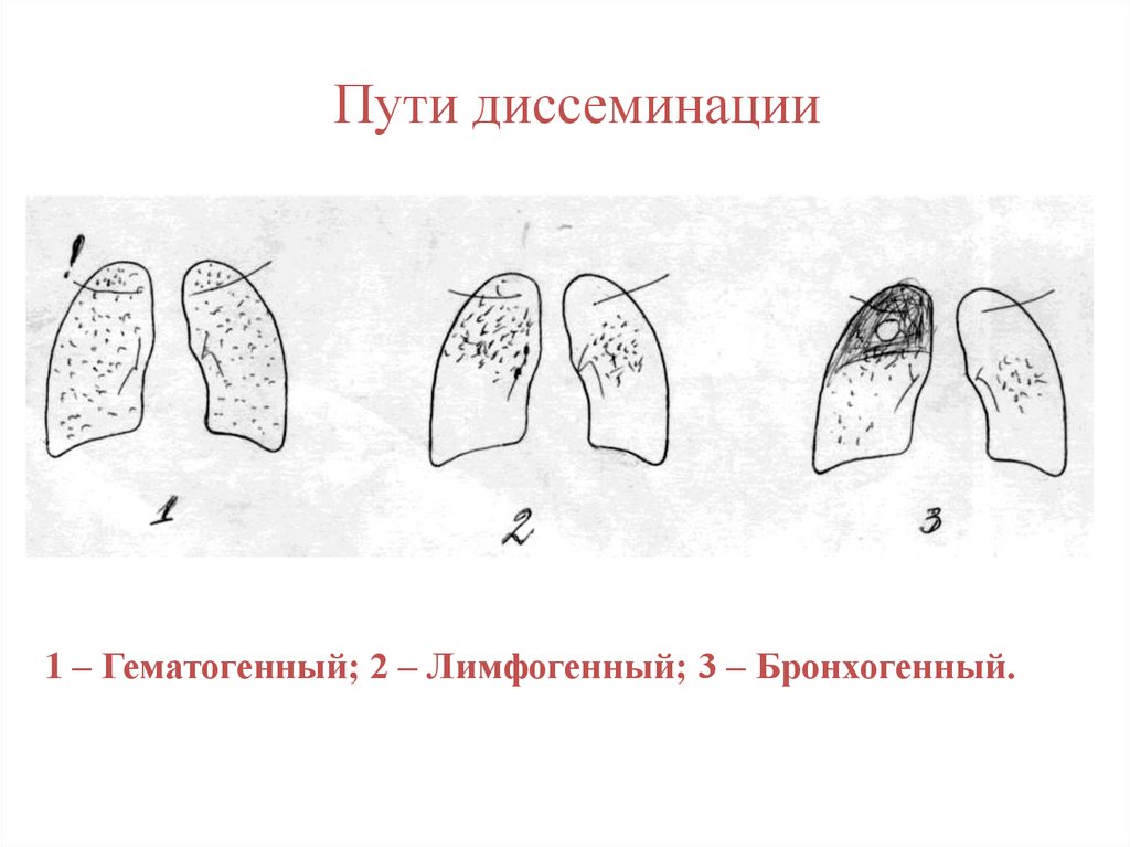 Милиарный туберкулез легких схема