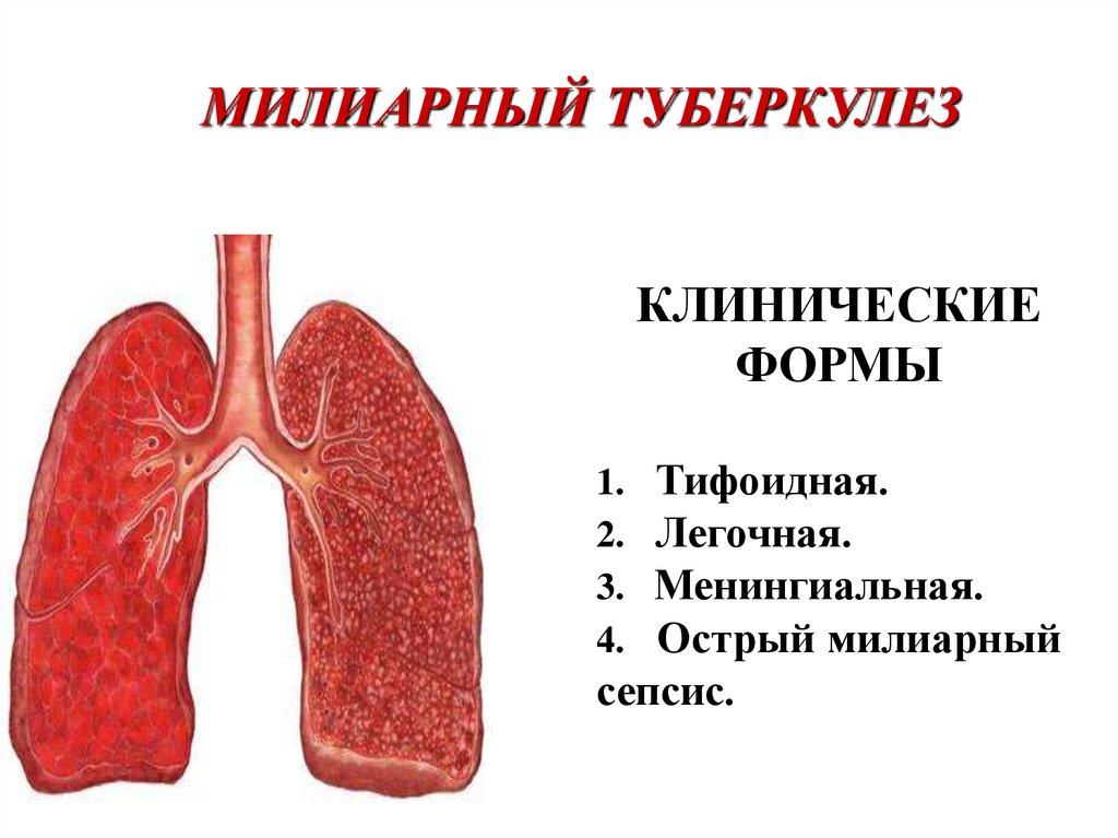 Милиарный туберкулез. Формы милиарного туберкулеза. Острый милиарный туберкулез. Легочная форма милиарного туберкулеза.