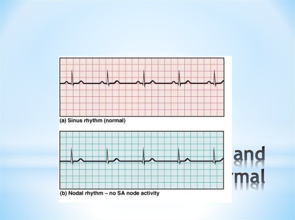 ECGs, Normal and Abnormal