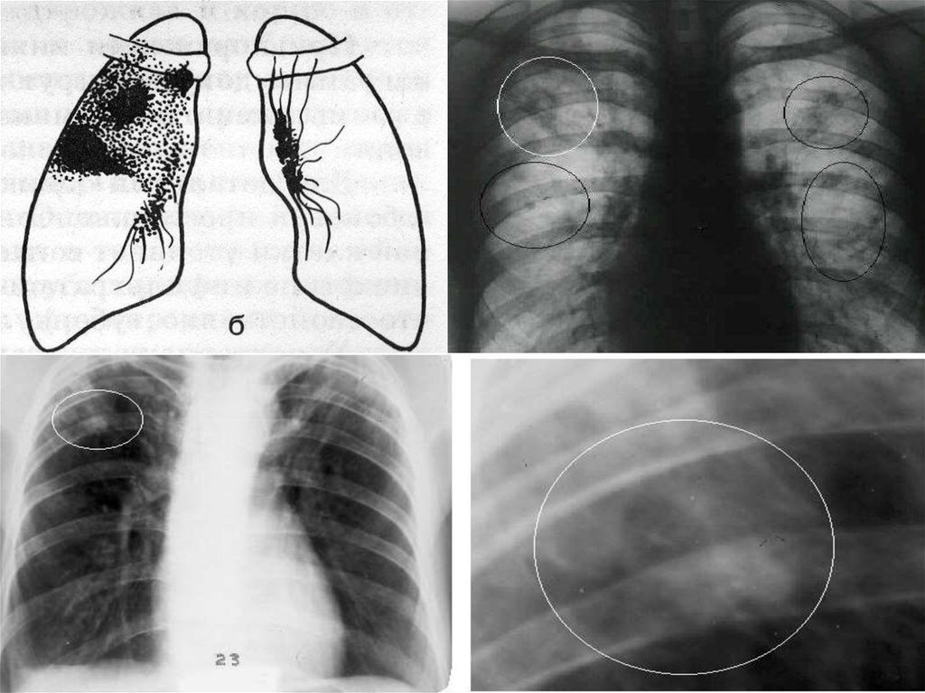Рентгенологическая картина. Туберкулез легких лучевая диагностика фтизиатрия. Диссеминированный туберкулез флюорография. Рентгенодиагностика туберкулеза. Рентгенологическая картина туберкулеза.