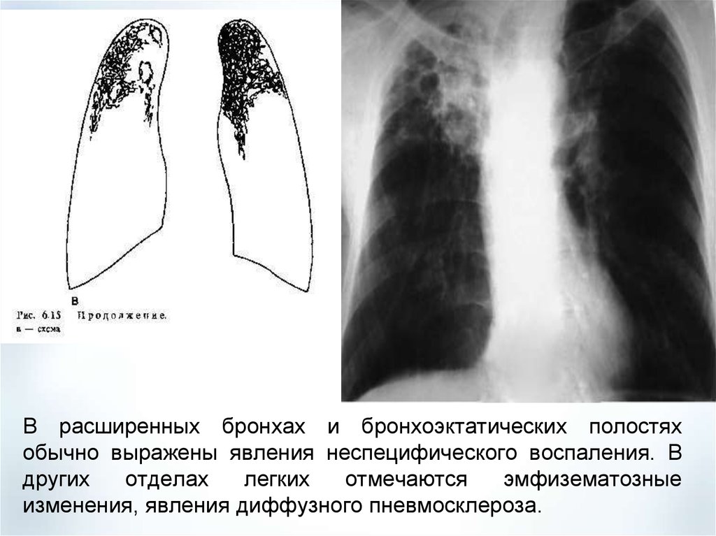 Изменение легочного рисунка