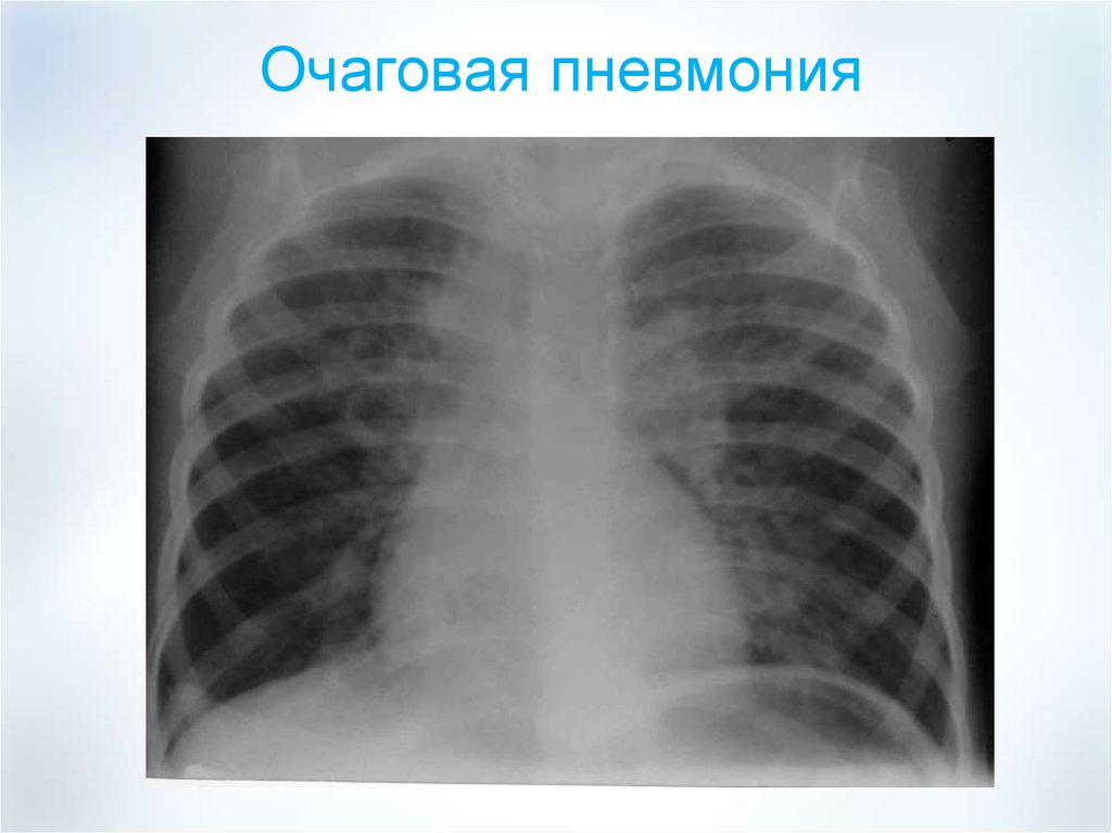 Картина очаговых. Правосторонняя очаговая пневмония рентген. Очаговая пневмония рентген. Очаговая пневмония рентгенограмма. Снимок легких на выдохе.