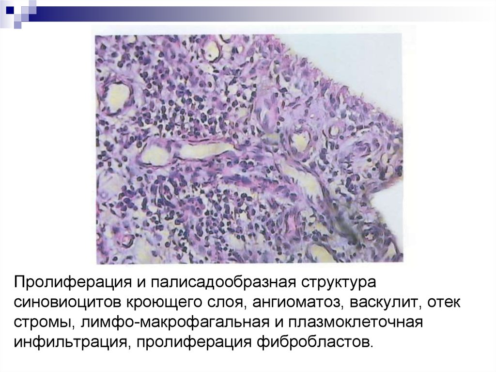 Пролиферация это. Лимфоклеточная пролиферация. Пролиферация фибробластов гистология. Клеточная пролиферация гистология. Пролиферация патанатомия.