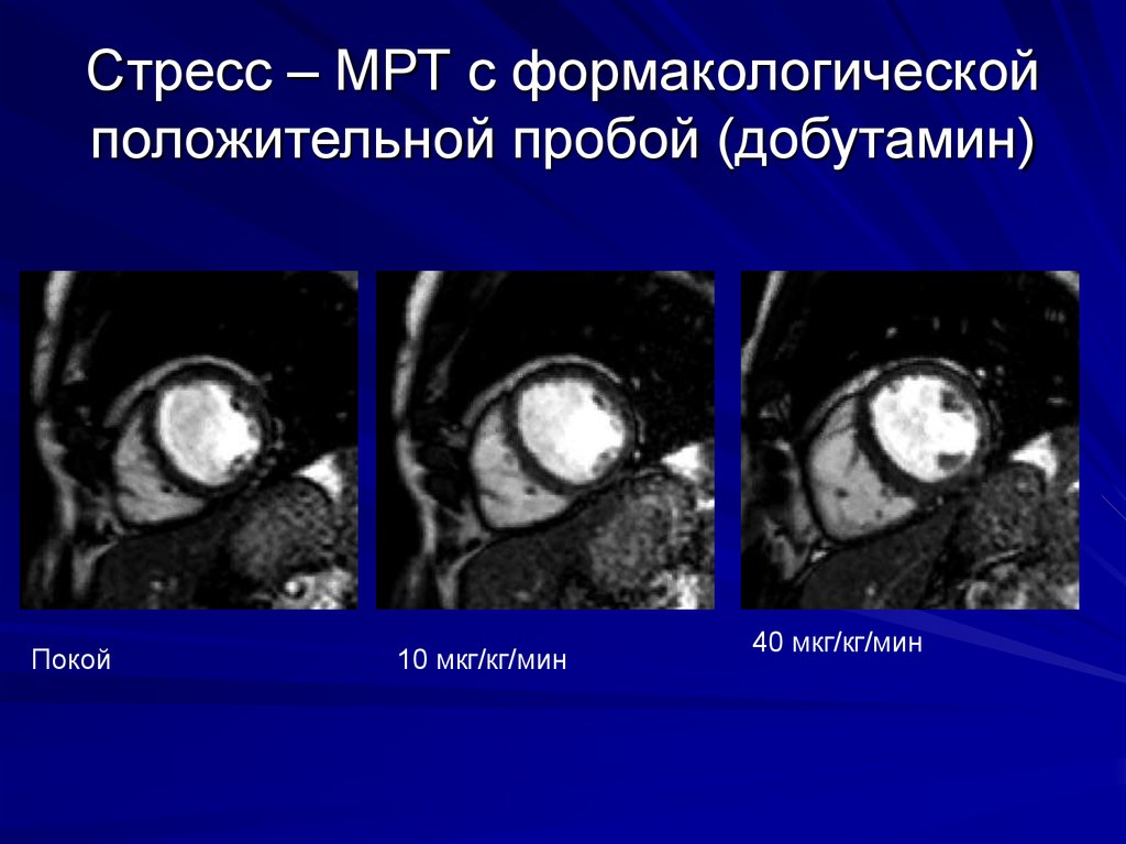 Children  Free Full-Text  Safety and Efficacy of Regadenoson for  Pediatric Stress Perfusion Cardiac MRI with Quantification of Myocardial  Blood Flow