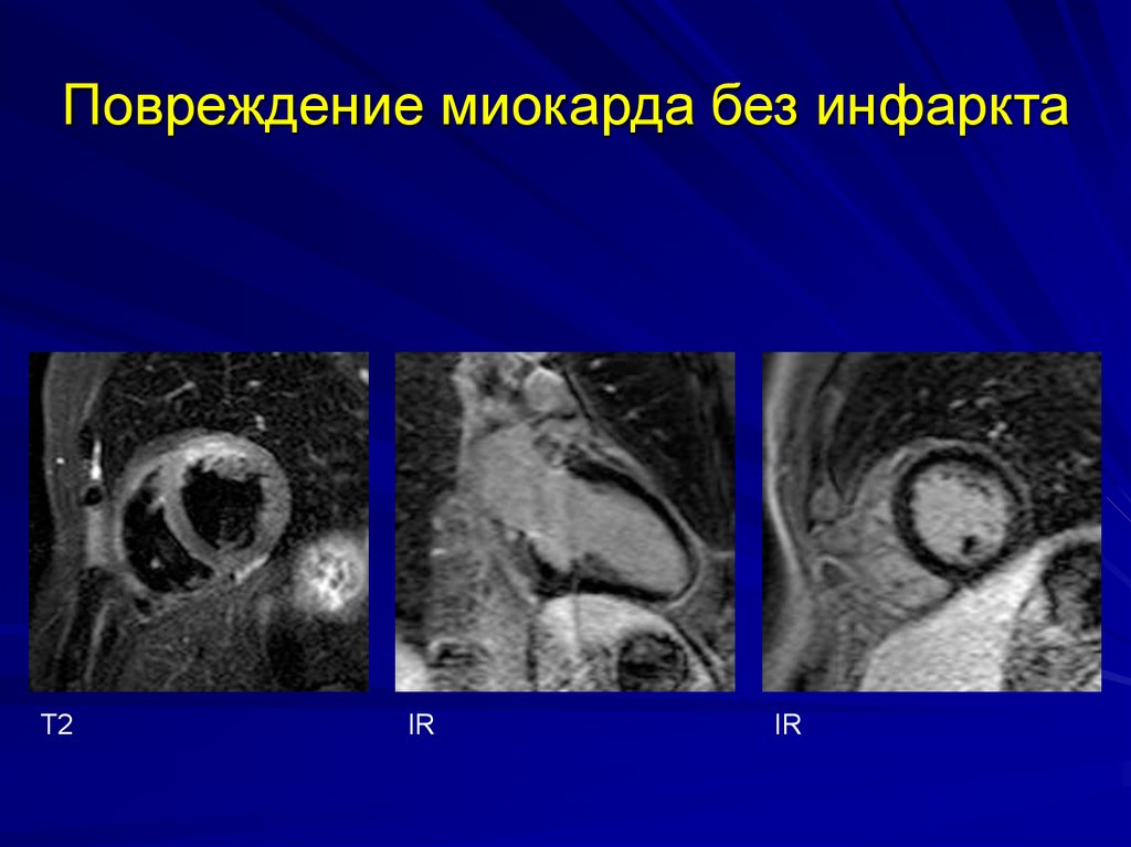 Разрыв миокарда. Повреждение миокарда. Мрт инфаркт миокарда кт.