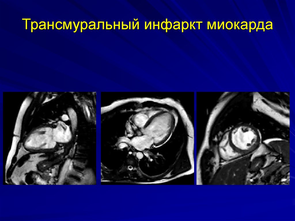 Спиральная компьютерная томография сердца с экг синхронизацией коронарный кальций са