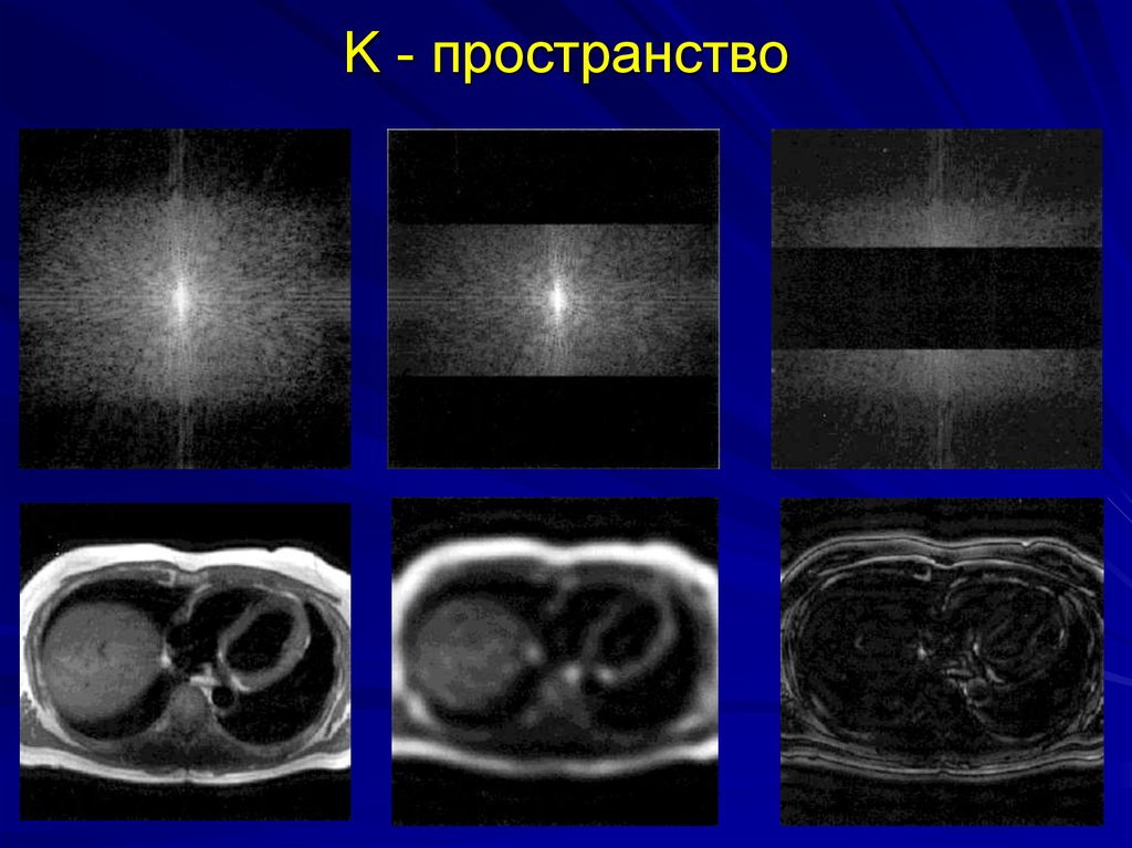 Пространство кт. К пространство мрт. K пространство. Шумы сердца томография. Компьютерная томография сердца в системе Полярных координат.