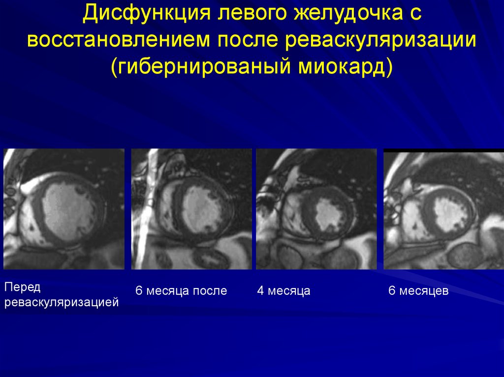 Дисфункция левого желудочка. Реабилитация после реваскуляризации миокарда.