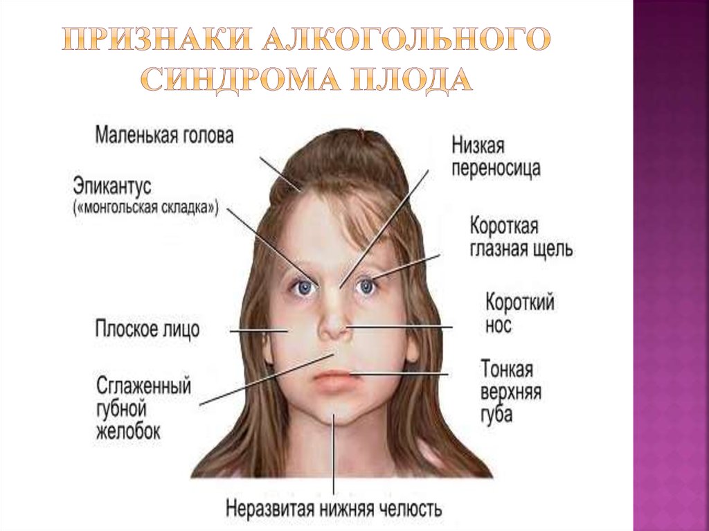 Фетально алкогольный. Фетальный алкогольный синдром. ФАС фетальный алкогольный синдром. Алкогольный синдром плода биология. Фетальный алкогольный синдром плода симптомы.