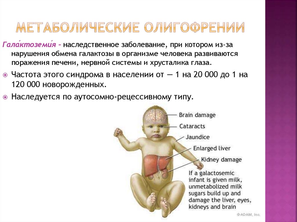 Галактоземия признаки заболевания. Характерная особенность болезни- галактоземия. Синдромы при галактоземии. Галактоземия и умственная отсталость.