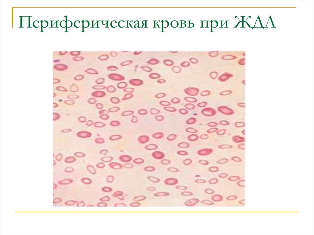 Картина периферической крови при железодефицитной анемии