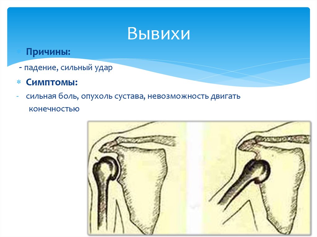 Вывих конечности признаки