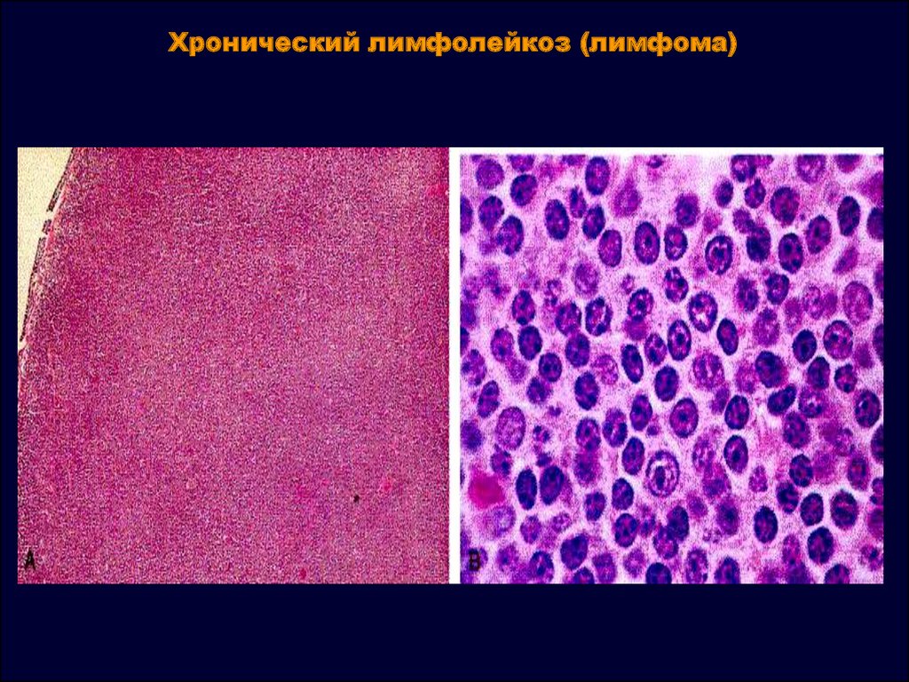 Злокачественные новообразования лимфоидной кроветворной ткани