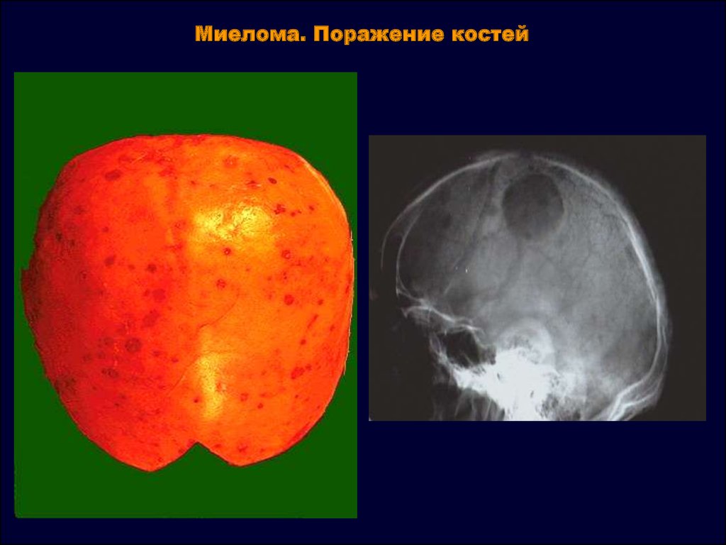 Поражение костей. Миеломная болезнь поражение костей. Миеломная болезнь поражение костей черепа. Солитарная миелома черепа.