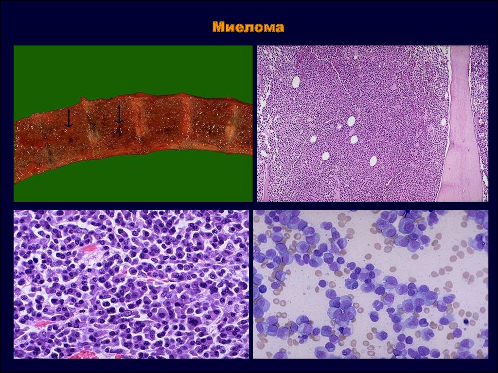 Миеломная болезнь костный мозг. Миеломная болезнь гистология. Миеломная болезнь костный мозг гистология. Плазмоклеточная миелома.