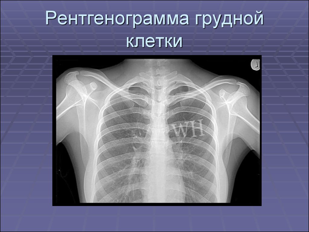 Флюорография в двух проекциях. Рентгенография грудной клетки (в 1-й проекции). Задняя проекция грудной клетки рентген. Рентген грудной клетки в прямой проекции. Рентгенограмма грудной клетки.