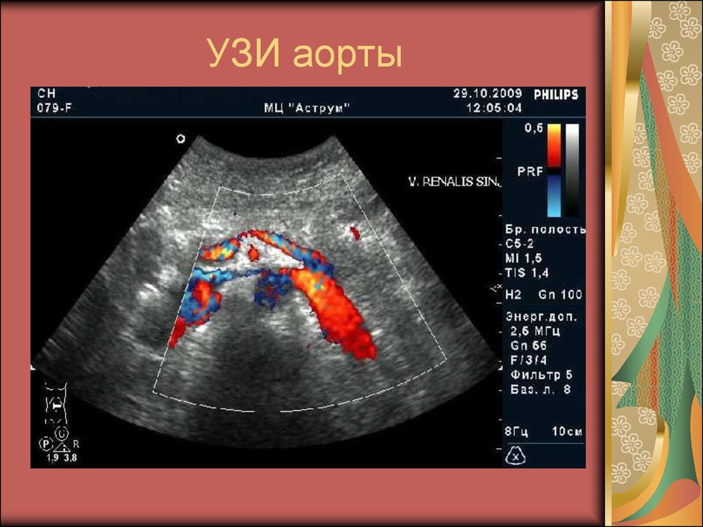 Уплотнение аорты сердца на узи