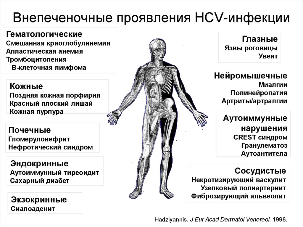 Гепатит с симптомы у женщин. Внепеченочные проявления хронических вирусных гепатитов.