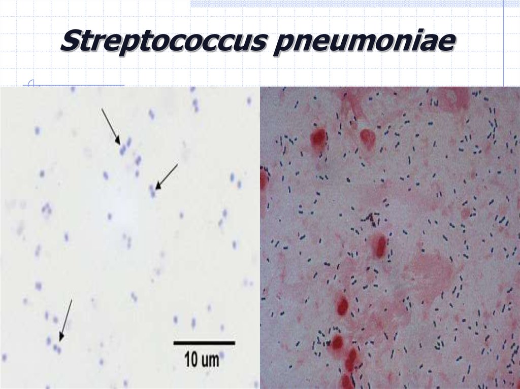 Streptococcus pneumoniae.
