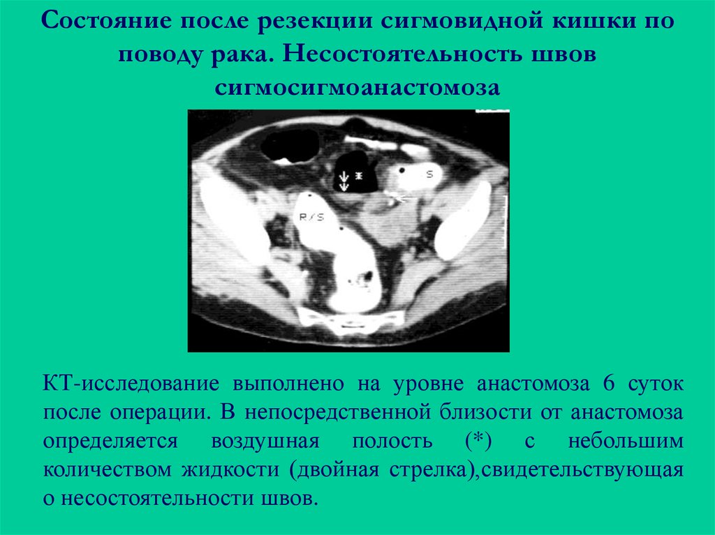 Рак сигмовидной диета. Опухоль сигмовидной кишки на кт. Несостоятельность швов анастомоза.