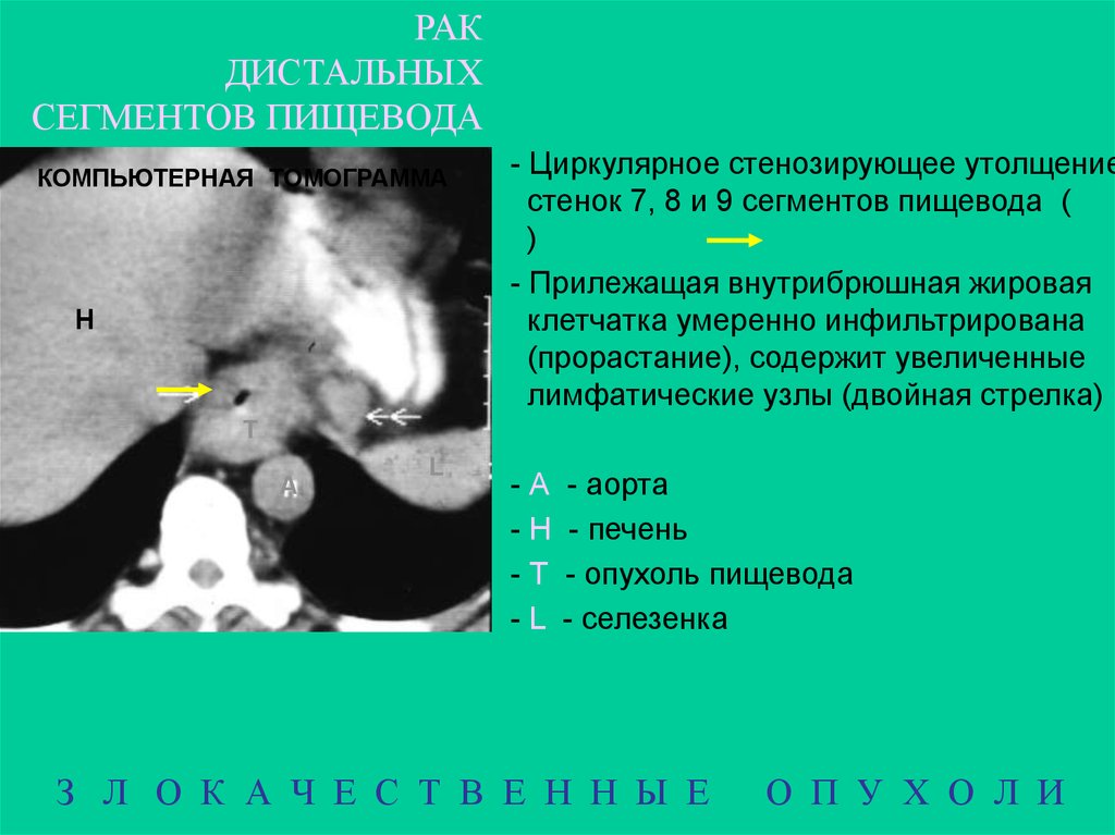 Рак пищевода метастазы