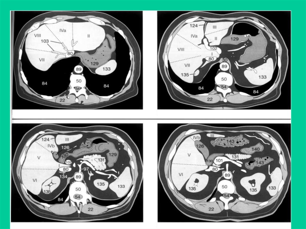Сегменты печени на кт схема