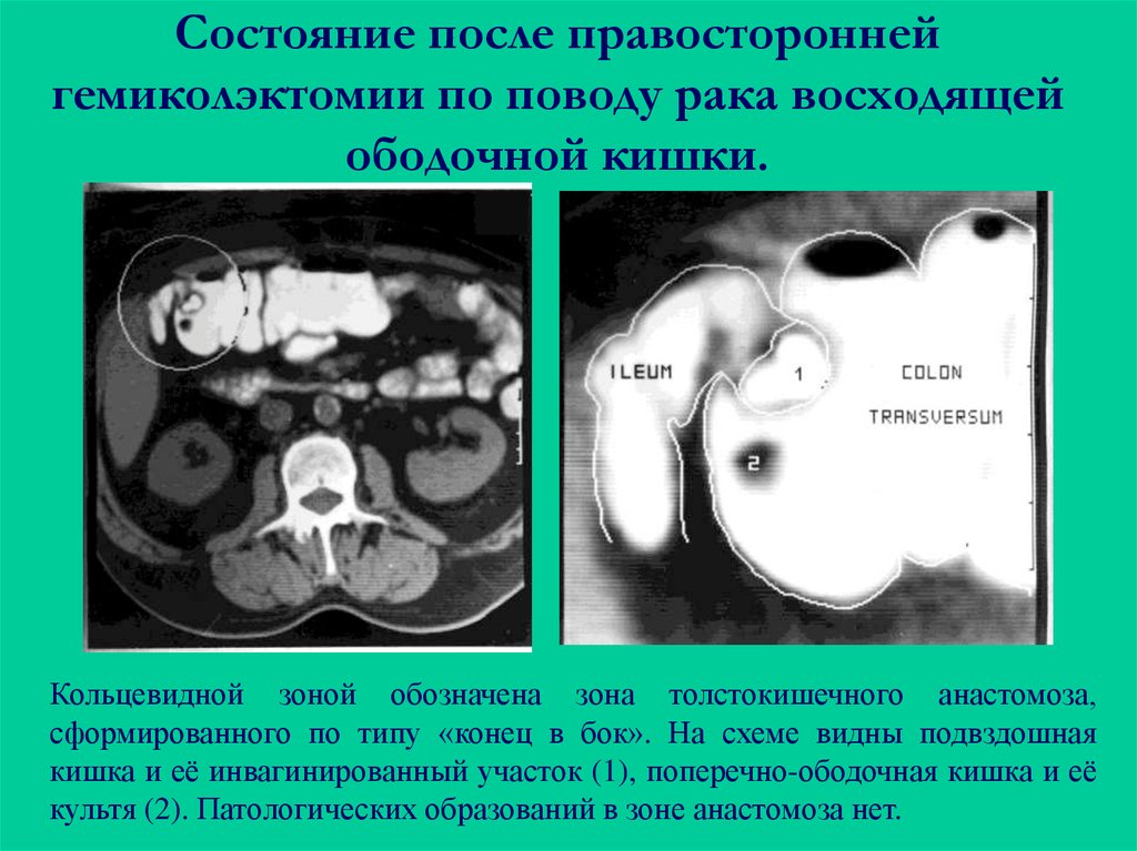 Состояние после. Правосторонняя гемиколэктомия кт. Опухоль ободочной кишки кт. Состояние после правосторонней гемиколэктомии. Анатомия подвздошной кишки на кт.