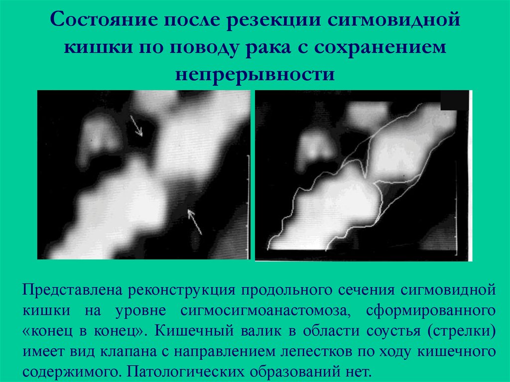 Состояние после. Опухоль сигмовидной кишки на кт. Кт при опухоли сигмовидной кишки. Кт после резекции сигмовидной кишки. Злокачественное образование сигмовидной кишки.