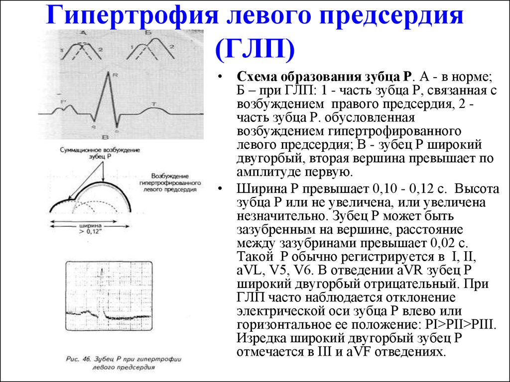 Глж на экг что это значит. Двугорбый зубец r на ЭКГ. Гипертрофия левого предсердия на ЭКГ. Гипертрофия правого предсердия v1 v2. При гипертрофии правого предсердия амплитуда зубца р.