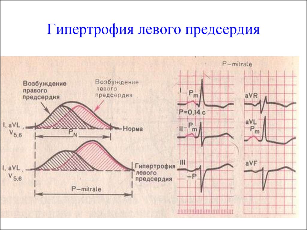 Расширение предсердий