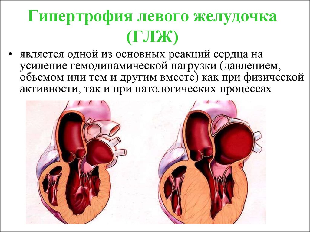 Глж сердца. Левый желудочек сердца гипертрофирован. ИБС гипертрофия левого желудочка. Гипертрофия миокарда левого желудочка при артериальной гипертензии. Дислипидемия. Гипертрофия левого желудочка..