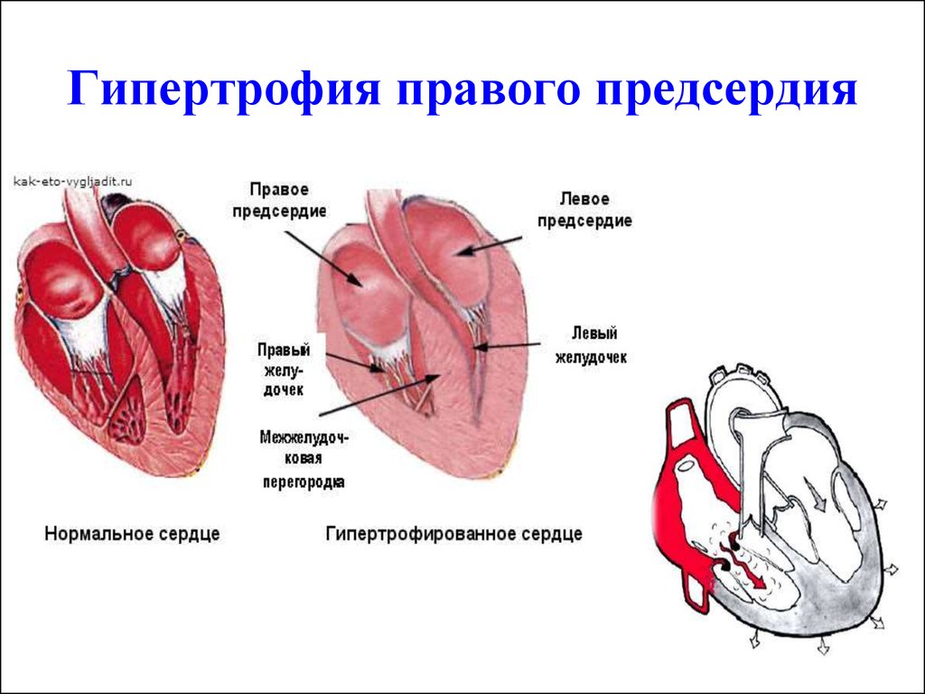 Гипертрофия миокарда рисунок